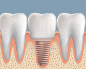 ImplantSuccess