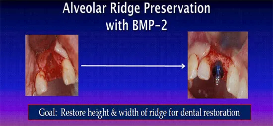 Alveolar Ridge Preservation with BMP-2 | Goal: Restore height & width of ridge for dental restoration