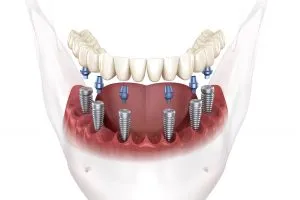 full dental implants Portland OR