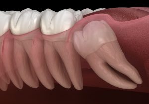 impacted tooth surgeon oregon